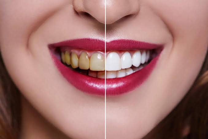 بطريقة صحية وسريعة.. أفضل وصفات تبييض الأسنان من الاصفرار بنسبة 100%.. ابتسامتك هتنور!