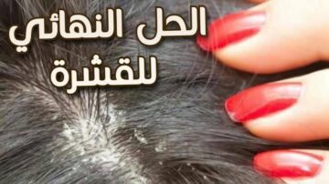 خلطة سحرية للتخلص من قشرة الشعر في أسرع وقت