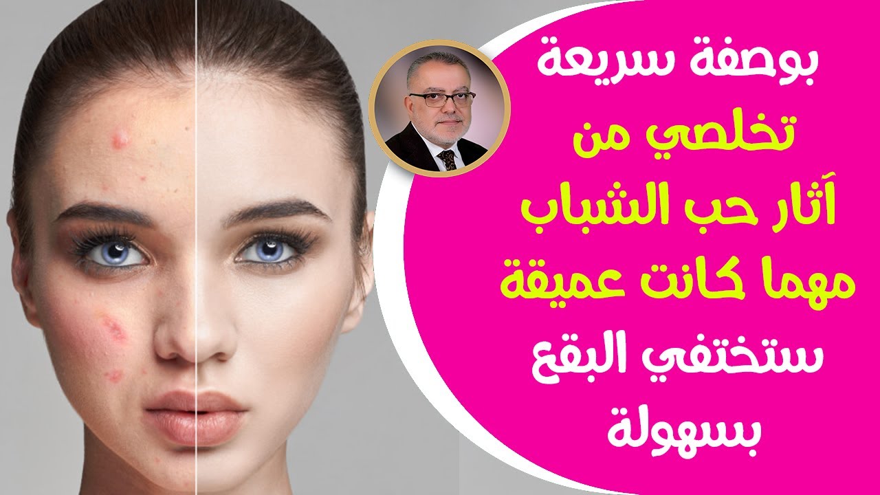 تفتيح البشرة وإزالة الحبوب بكل سهولة بوصفات طبيعية وآمنة