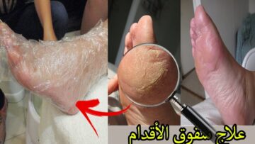 عمرى ما تخيلت النتيجة.. بشويه خل وجليسرين وقولي وداعا لتشققات القدمين والشخونة تقشير وتبييض مثل الاطفال في دقائق كعيك هينور