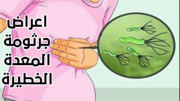 ما هي أعراض وأسباب جرثومة المعدة وما هو طرق علاجها؟