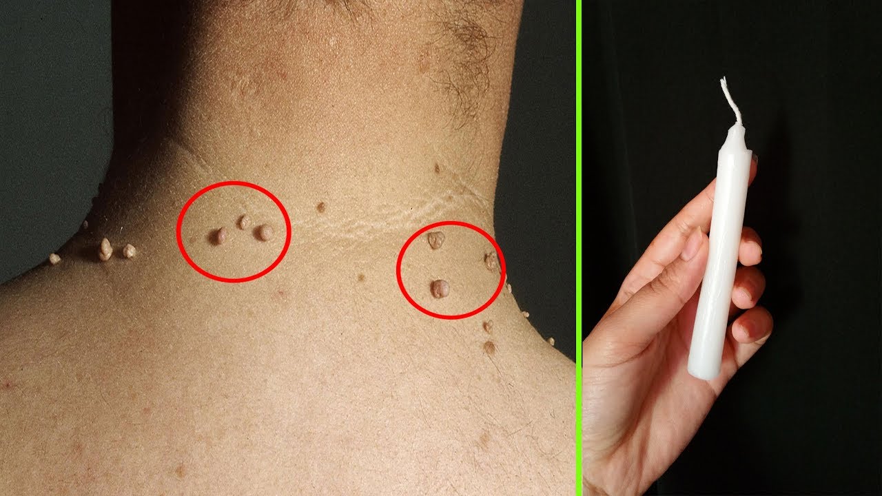 مسحة واحدة ستخلصك من الزوائد الجلدية أو الثالول مهما كان حجمها 5 مسحة واحدة ستخلصك من الزوائد الجلدية أو الثالول مهما كان حجمها