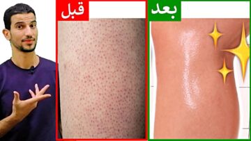 وصفات طبيعية لعلاج جلد الوزة بالساقين… هتلاحظي الفرق خلال أيام