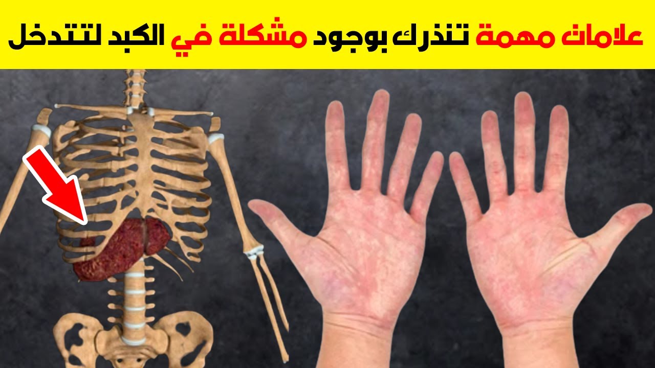 الأطباء يحذرون علامات تدل على أن الكبد ملئ بالسموم استشر الطبيب فورا 5 الأطباء يحذرون علامات تدل على أن الكبد ملئ بالسموم استشر الطبيب فورا