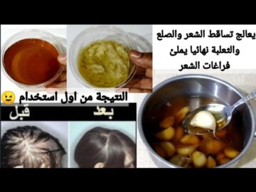 لن تعاني من تساقط الشعر بعد اليوم بخلطة الثوم والقرنفل ضعيها علي فراغات شعرك تعالج الصلع الثعلبة