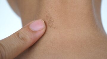 أسباب سواد الرقبة عند الأطفال