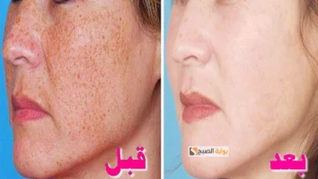 سيروم العرق سوس لإزالة الكلف والنمش هتنوري من تاني وتبقى نمبر وان