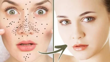 طرق التخلص من الرؤوس السوداء بسهولة