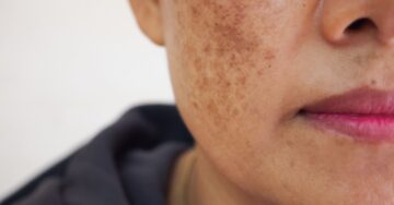 بديل المكياج الأرخص.. 4 مكونات طبيعية للتخلص من النمش نهائيًا