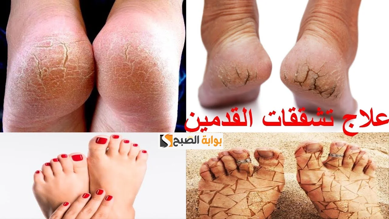 مقشر الملح مع الفازلين والترمس لإزالة تشققات القدمين والجلد في فصل الشتاء "رجلك هتبقى زي البلور" 5 مقشر الملح مع الفازلين والترمس لإزالة تشققات القدمين والجلد في فصل الشتاء “رجلك هتبقى زي البلور”