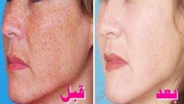لو بتعانى من كلف الحمل.. تقشير الكلف في البيت بوصفات طبيعية