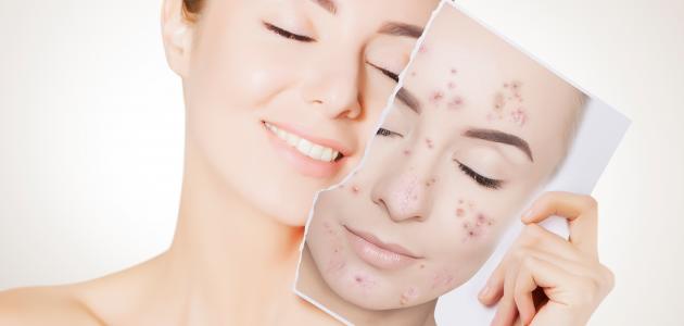 علاج حب الشباب طبيعياً بسرعة بالمنزل بأقل التكاليف الممكنة 5 علاج حب الشباب طبيعياً بسرعة بالمنزل بأقل التكاليف الممكنة