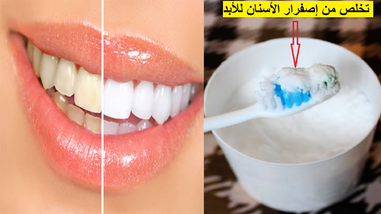 وصفة للتخلص من اصفرار الأسنان والجير نهائيا في المنزل بطرق طبيعية وإعادة الابتسام البيضاء 5 وصفة للتخلص من اصفرار الأسنان والجير نهائيا في المنزل بطرق طبيعية وإعادة الابتسام البيضاء