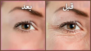 وداعا لتجاعيد الوجه.. علاج تجاعيد الوجه في المنزل بوصفات طبيعية