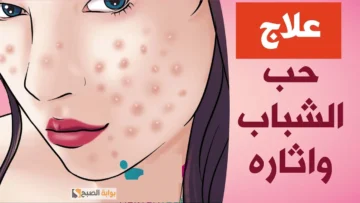 العشبة الخضراء المعجزة لإزالة البثور وعلاج ندبات حب الشباب “بشرتك هتبقى صافية وزي البدر”