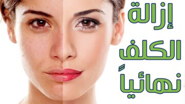 الخلطة السحرية لتبييض الوجه وعلاج الكلف والنمش بشكل طبيعي ونهائياً لبشرة صافية وجميلة