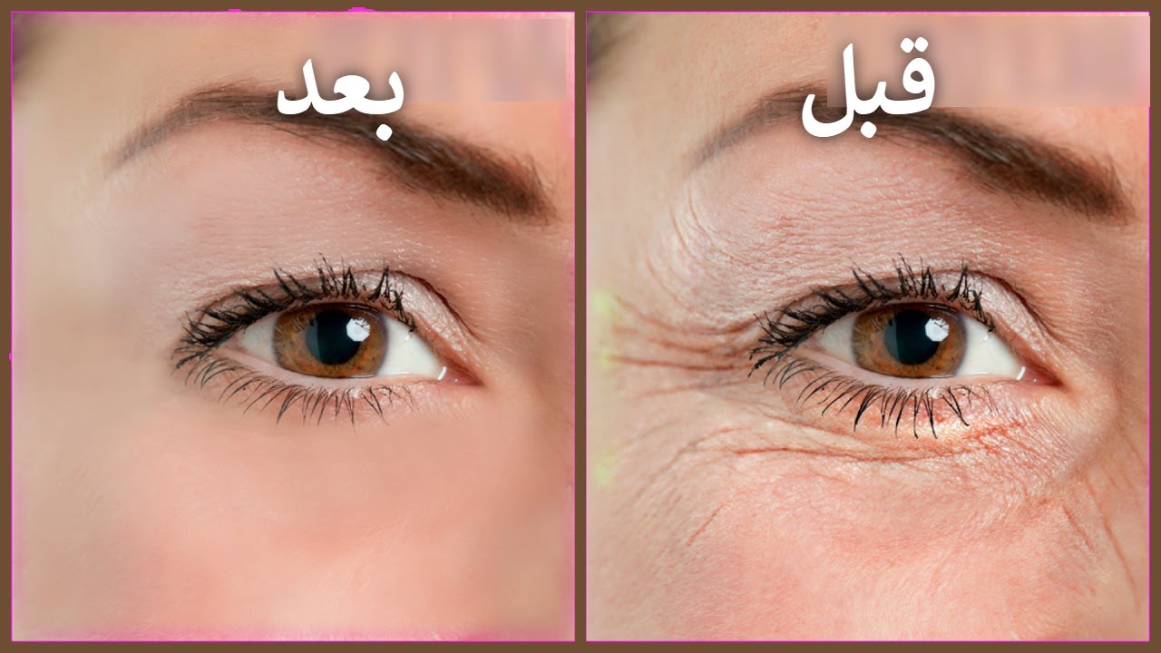 جربي إزاي تتخلصي من تجاعيد وانتفاخات حول العين بمكونات منزلية وغير مكلفة 5 جربي إزاي تتخلصي من تجاعيد وانتفاخات حول العين بمكونات منزلية وغير مكلفة