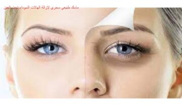 إزاي تتخلصي من الهالات السوداء بسرعة؟ 5 وصفات طبيعية سحرية وآمنة تمامًا