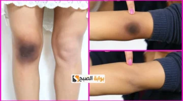 وصفة السكر والقهوة لتقشير الركب و الأكواع