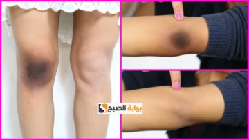 ماسك السكر والقهوة لتفتيح الركب والأكواع “بـ 30 جنيه بس ستودعين اسمرار الركبة نهائيًا”