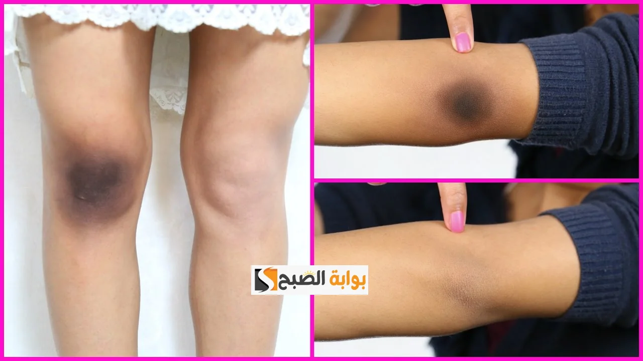 ماسك السكر والقهوة لتفتيح الركب والأكواع “بـ 30 جنيه بس ستودعين اسمرار الركبة نهائيًا”