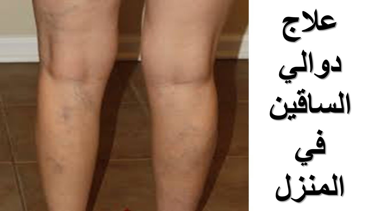 امرأة عجوز وصفت لي هذه الوصفة بحبة طماطم واحدة قضت علي الدوالي ولم يعد لها اثر 5 امرأة عجوز وصفت لي هذه الوصفة بحبة طماطم واحدة قضت علي الدوالي ولم يعد لها اثر