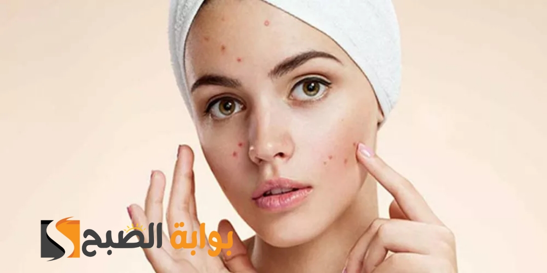 لبشرة صافية أفضل وصفة لإزالة الحبوب من الوجه في يوم واحد والتخلص من البثور 5 لبشرة صافية أفضل وصفة لإزالة الحبوب من الوجه في يوم واحد والتخلص من البثور