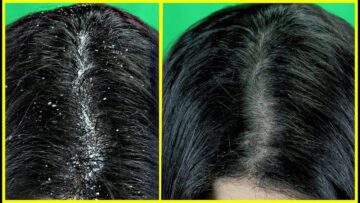 هاتي كوب خل تفاح وتعالي أقولك أزاي تتخلصي من قشرة الشعر في ساعة واحدة بس