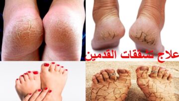 كعب رجلك هيبقي قشطة منور بمكون الفازلين هيزيل القشور والجلد الميت