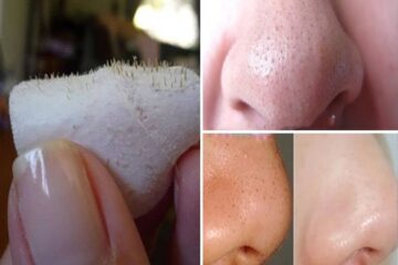 علشان متحسيش بالإحراج منها … وصفات التخلص من الرؤوس السوداء في الأنف والذقن