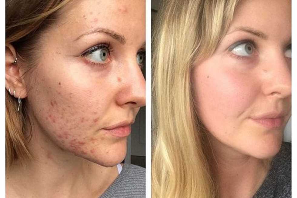 وصفة طبيعية لعلاج حب الشباب واثاره من الوجه 5 وصفة طبيعية لعلاج حب الشباب واثاره من الوجه