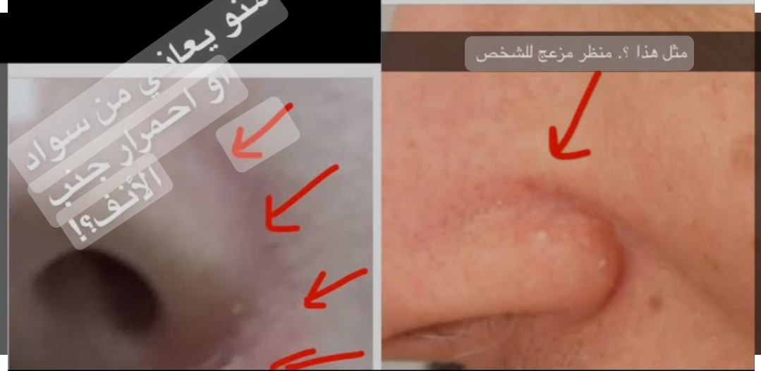 بدون كريمات ولا كوافير.. طرق طبيعية لإزالة الإسمرار حول الأنف
