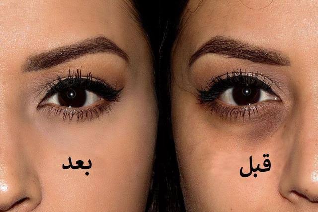 علاج طبيعي مفعوله سحري للتخلص من الهالات السوداء نهائياً 5 علاج طبيعي مفعوله سحري للتخلص من الهالات السوداء نهائياً