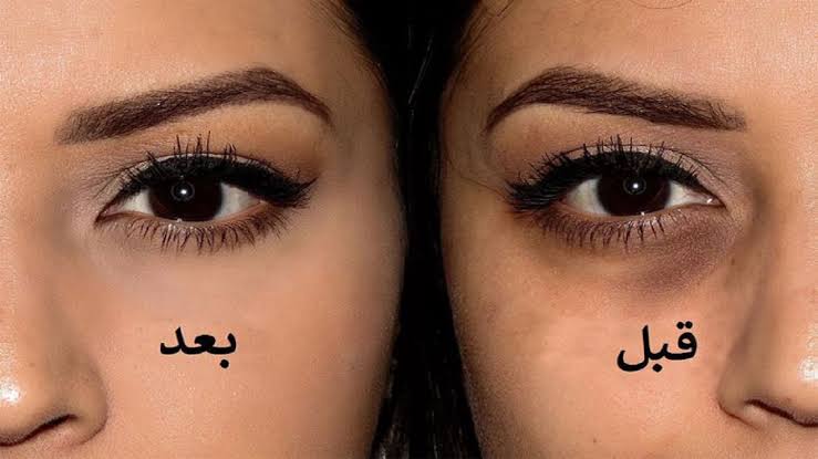 خلي عيونك ترجع تنور.. وصفة طبيعية لعلاج الهالات السوداء وإعادة بشرتك إلى رونقها