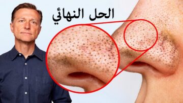 طريقة لإزالة الرؤوس السوداء من الوجه والأنف نهائيا بمكونات موجودة في مطبخك وبأقل التكاليف بشرتك هتبقى كبشرة الاطفال