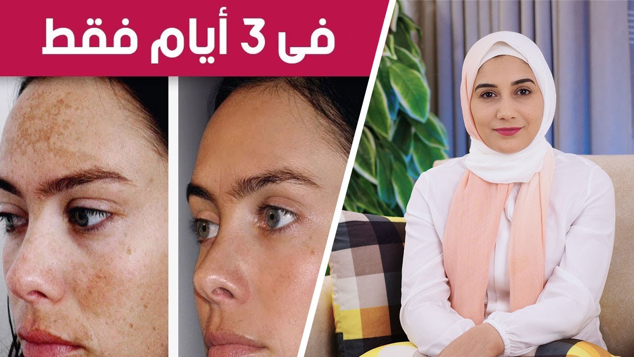 تركيبة فعالة من الطبيعية تقضي على الكلف وآثار البقع من عمق البشرة وجعلها كالقمر 5 تركيبة فعالة من الطبيعية تقضي على الكلف وآثار البقع من عمق البشرة وجعلها كالقمر