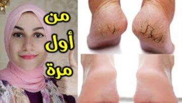 تخلص من مصدر الاحراج.. مكون سحري للقضاء على تشققات القدمين بكل سهولة