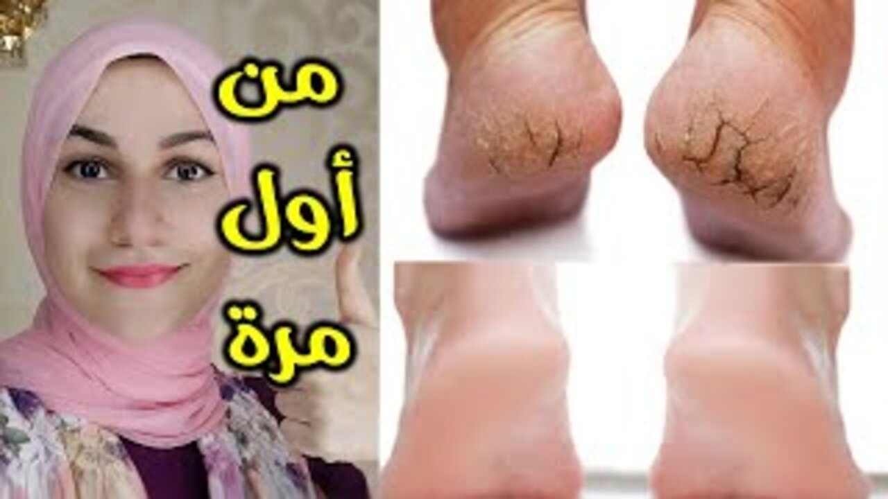 تخلص من مصدر الاحراج.. مكون سحري للقضاء على تشققات القدمين بكل سهولة 5 تخلص من مصدر الاحراج.. مكون سحري للقضاء على تشققات القدمين بكل سهولة