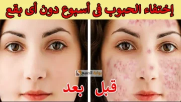 وصفة طبيعية باستخدام البيض للقضاء التام على حب الشباب والبثور بشرتك هتبقى بلور مضوي