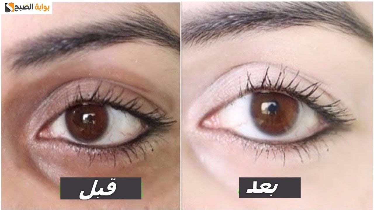 حل سحري للهالات السوداء تحت العين نهائياً بمكونات طبيعية 5 حل سحري للهالات السوداء تحت العين نهائياً بمكونات طبيعية