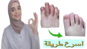 التخلص من برودة الأطراف في فصل الشتاء.. طريقة مجربة لعلاج تورم اليدين والقدمين من البرد