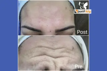 منها جل الصبار.. وصفات طبيعية للتخلص من تجاعيد الجبين للحصول على وجه أكثر شبابا