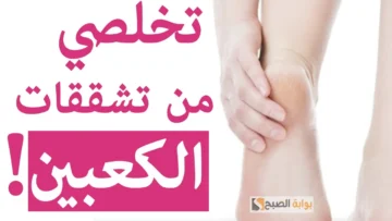 خلطة سحرية للتخلص من تشققات الكعبين مع تنعيم وتبييض للقدمين “رجلك هتنور”