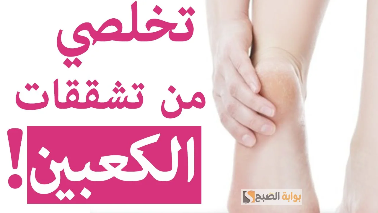 خلطة سحرية للتخلص من تشققات الكعبين مع تنعيم وتبييض للقدمين "رجلك هتنور" 5 خلطة سحرية للتخلص من تشققات الكعبين مع تنعيم وتبييض للقدمين “رجلك هتنور”