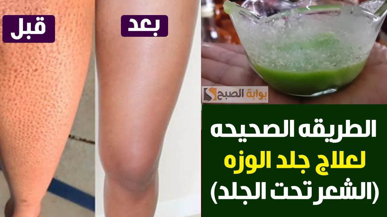 وصفات طبيعية هتقضى على مشكلة جلد الوزة وهتخلى بشرتك زى الحرير 5 وصفات طبيعية هتقضى على مشكلة جلد الوزة وهتخلى بشرتك زى الحرير