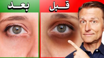 الهالات السوداء