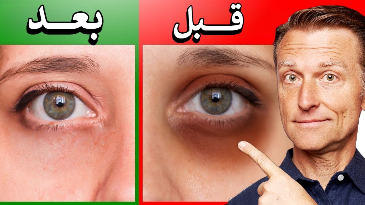 التخلص من الهالات السوداء بسرعة هتختفي نهائي ومن أول مرة 5 التخلص من الهالات السوداء بسرعة هتختفي نهائي ومن أول مرة