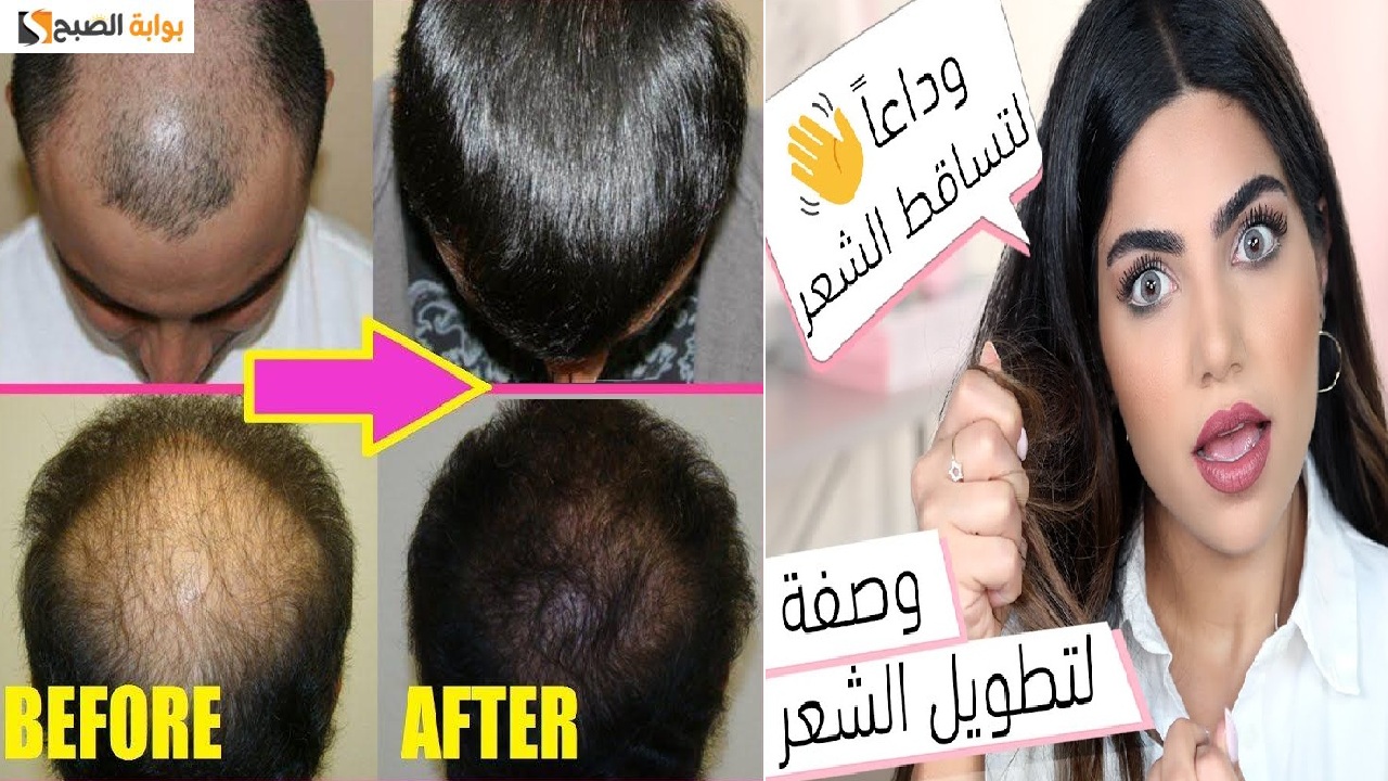 تساقط الشعر !! طريقة سحرية للقضاء على فراغات الشعر والتساقط 5 تساقط الشعر !! طريقة سحرية للقضاء على فراغات الشعر والتساقط