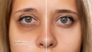 فعالة وسهلة الاستخدام.. طرق طبيعة لترطيب منطقة حول العين لحمايتها من التجاعيد