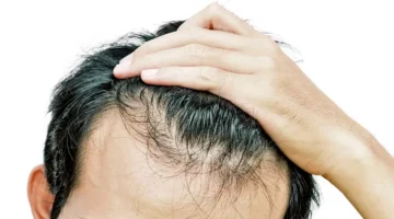 سبب تساقط الشعر عند سحبه